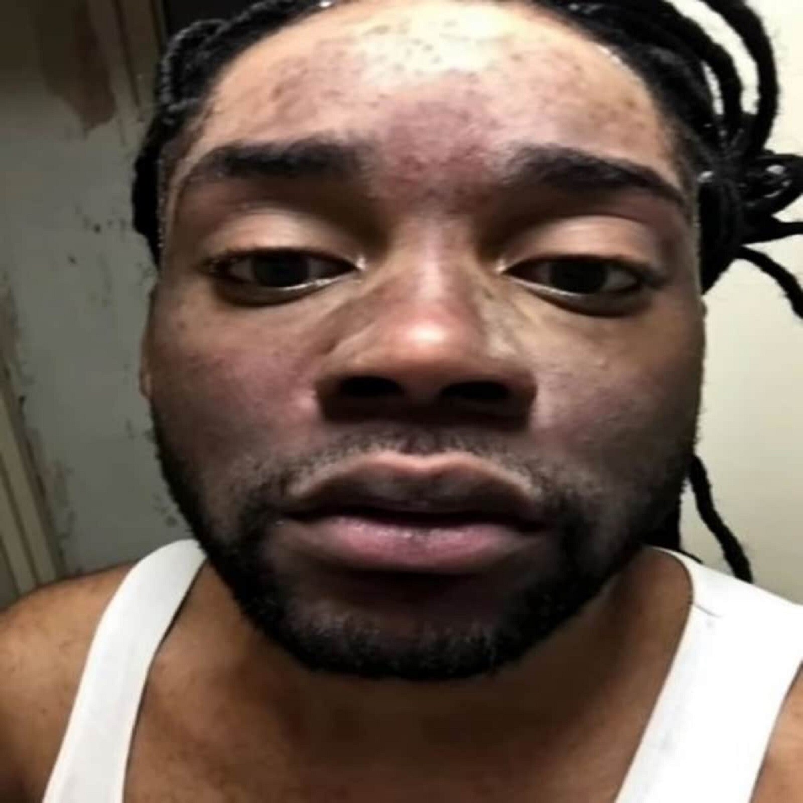 Man face bleach for 10 years every month now skin peeled off side