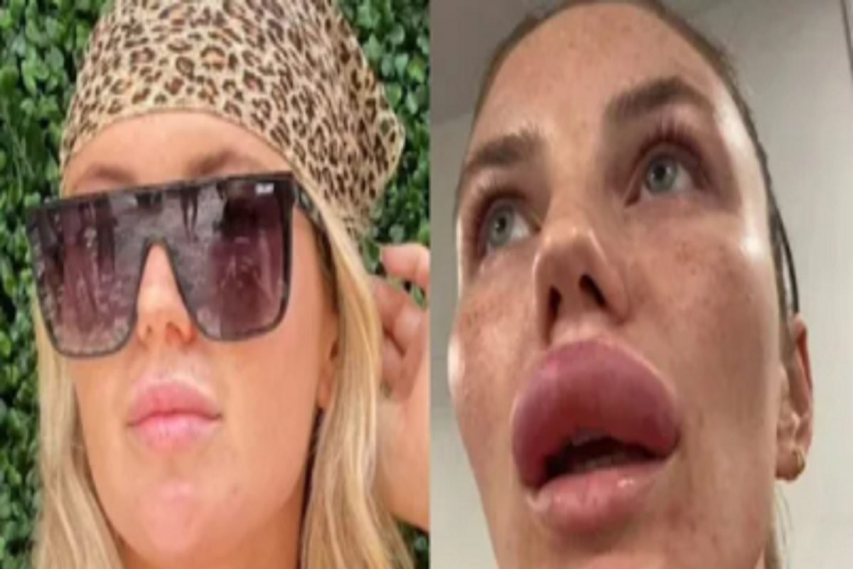 सुंदर दिसण्याच्या नादात भलतंच घडलं; ब्यूटी ट्रिटमेंटमुळे ओठांचा झाला भयंकर 'फुगा'