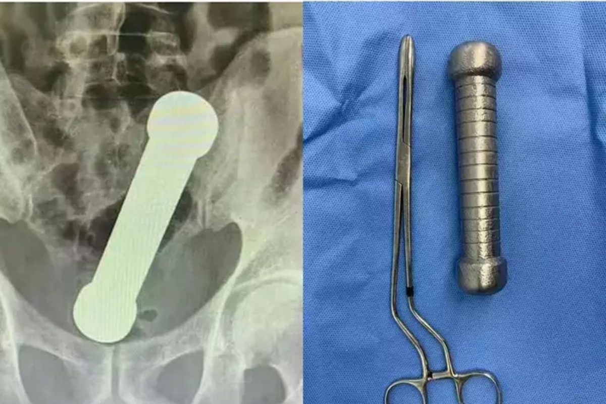 Dumbbell in Private Part: लैंगिक सुखाच्या नादात प्रायव्हेट पार्टमध्ये अडकला 2 Kg चा डंबेल, डॉक्टरही हैराण!