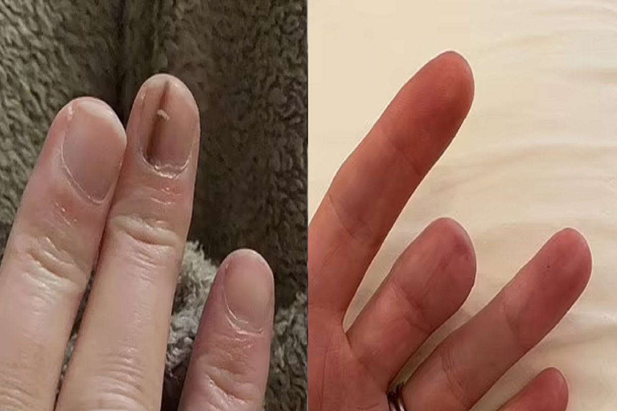 बापरे! नखावरील या साध्या डागामुळे महिलेला कापावं लागलं आपलं बोट; शॉकिंग आहे कारण
