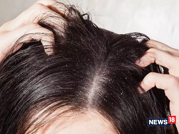 कोंडा निघून जाईल : केसांमध्ये सागरी मीठ नियमितपणे लावल्याने केसांचा कोरडेपणा कमी होतो. यासोबतच अँटी-बॅक्टेरियल घटक असलेले समुद्री मीठ केसांमधील ओलावा टिकवून ठेवत असल्याने कोंड्यामुळे होणारा त्रास कमी करते.