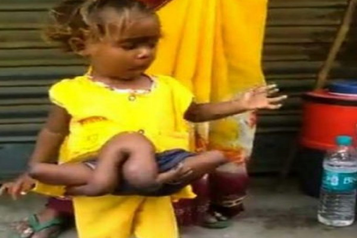 आश्चर्य! 4 पाय आणि 4 हात; विचित्र चिमुकलीला पाहून डॉक्टरही शॉक, उपचारासही दिला नकार