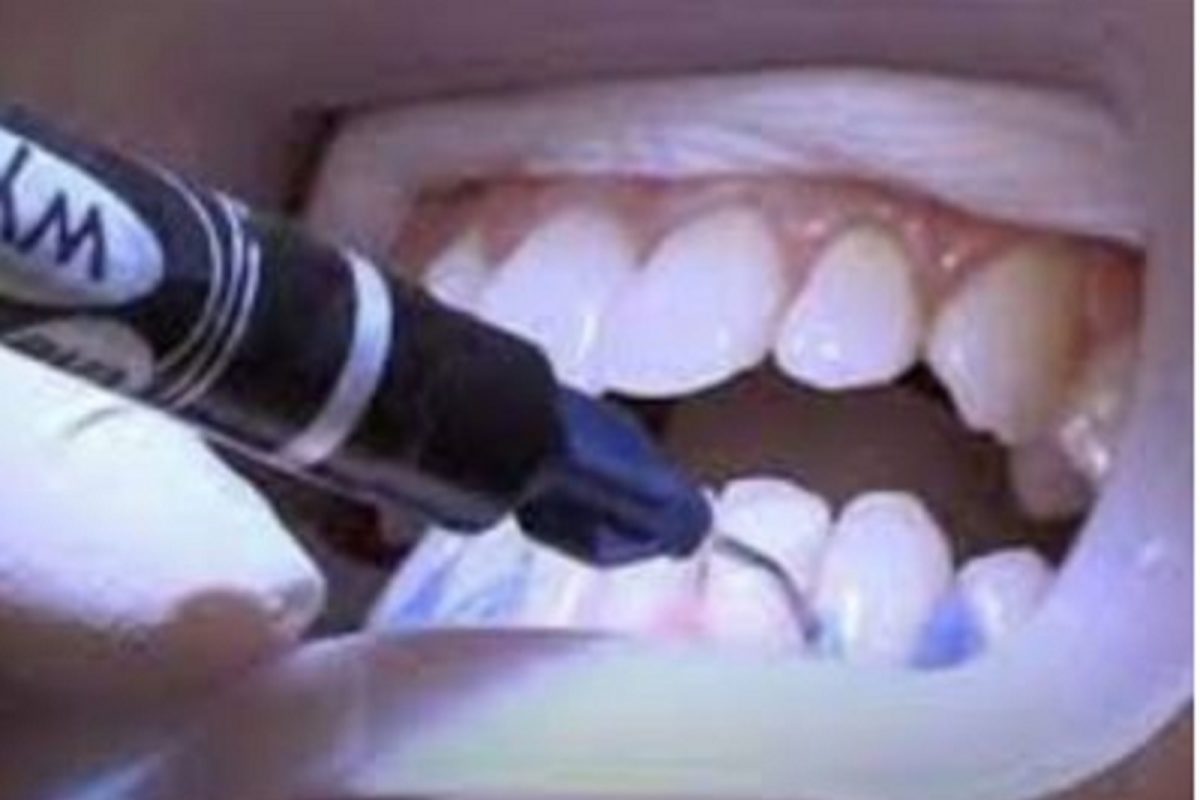 PHOTO - डिस्काऊंटच्या नादात दातांवर उपचारासाठी परदेशात गेली; तोंड उघडताच हादरली महिला