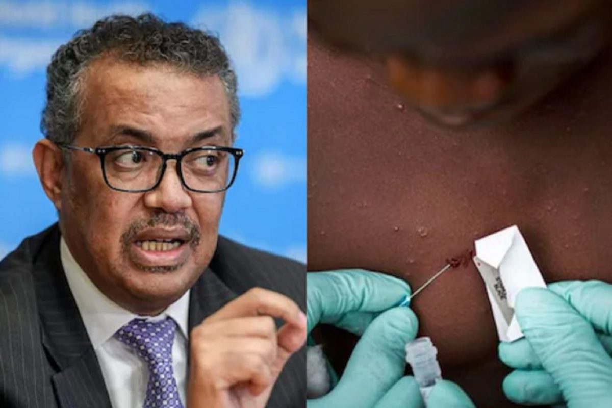 WHO नेही घेतला Monkeypox चा धसका; वाढती प्रकरणं पाहता तातडीने उचललं महत्त्वाचं पाऊल