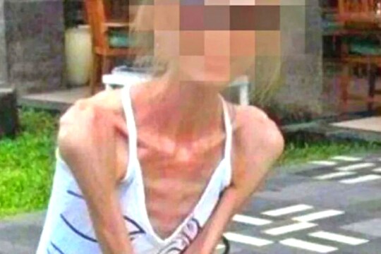 प्रसूतीनंतर वजन कमी करणं पडलं महागात; थेट जावं लागलं ‘आयसीयू’मध्ये