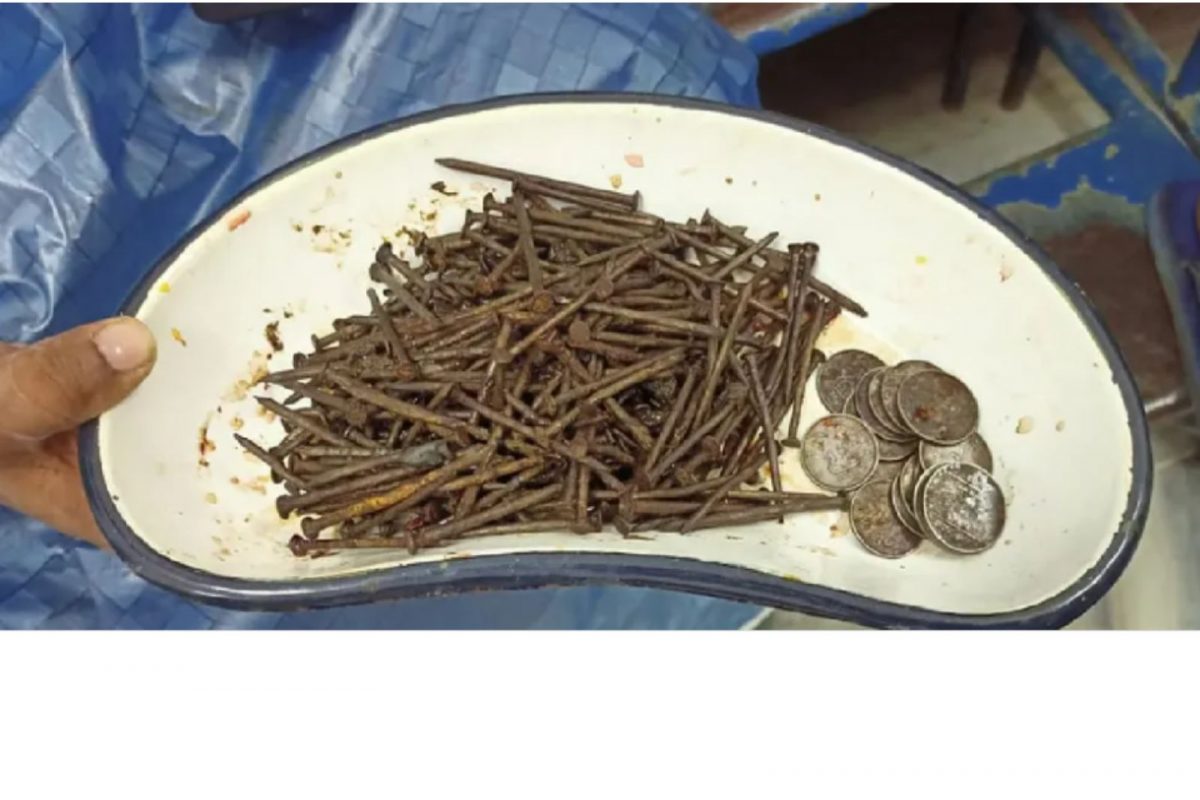 डॉक्टरही पाहून हादरले; तरुणाच्या पोटातून निघाले 250 खिळे, 35 नाणी आणि...