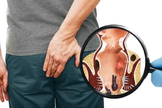 Piles Problem : मूळव्याधीचा त्रास नकोच असेल तर आहाराची आजपासूनच घ्या अशी काळजी
