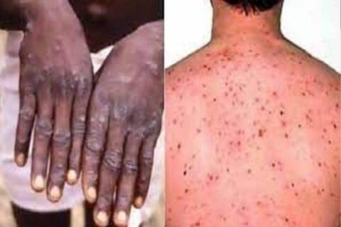 देशाची राजधानी असलेल्या दिल्लीत मंकीपॉक्सचा (Monkeypox)  पहिला रुग्ण समोर आल्यानंतर सर्वत्र भीतीदायक वातावरण आहे. 
