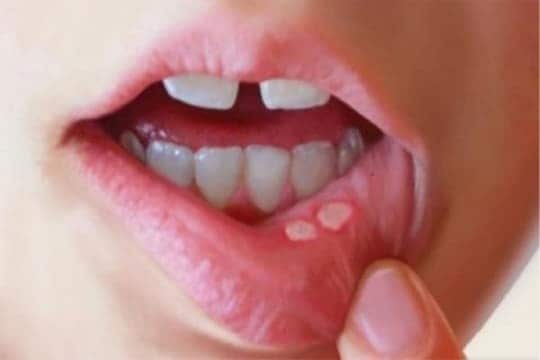 तोंडातील अल्सरकडे दुर्लक्ष करू नका, असू शकते काही आजारांचे प्राथमिक लक्षण