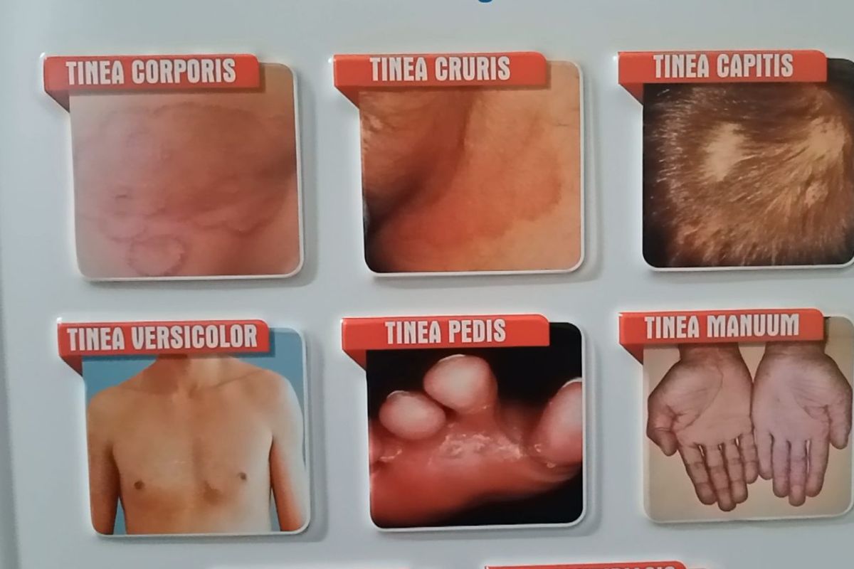 फंगल इन्फेक्शन