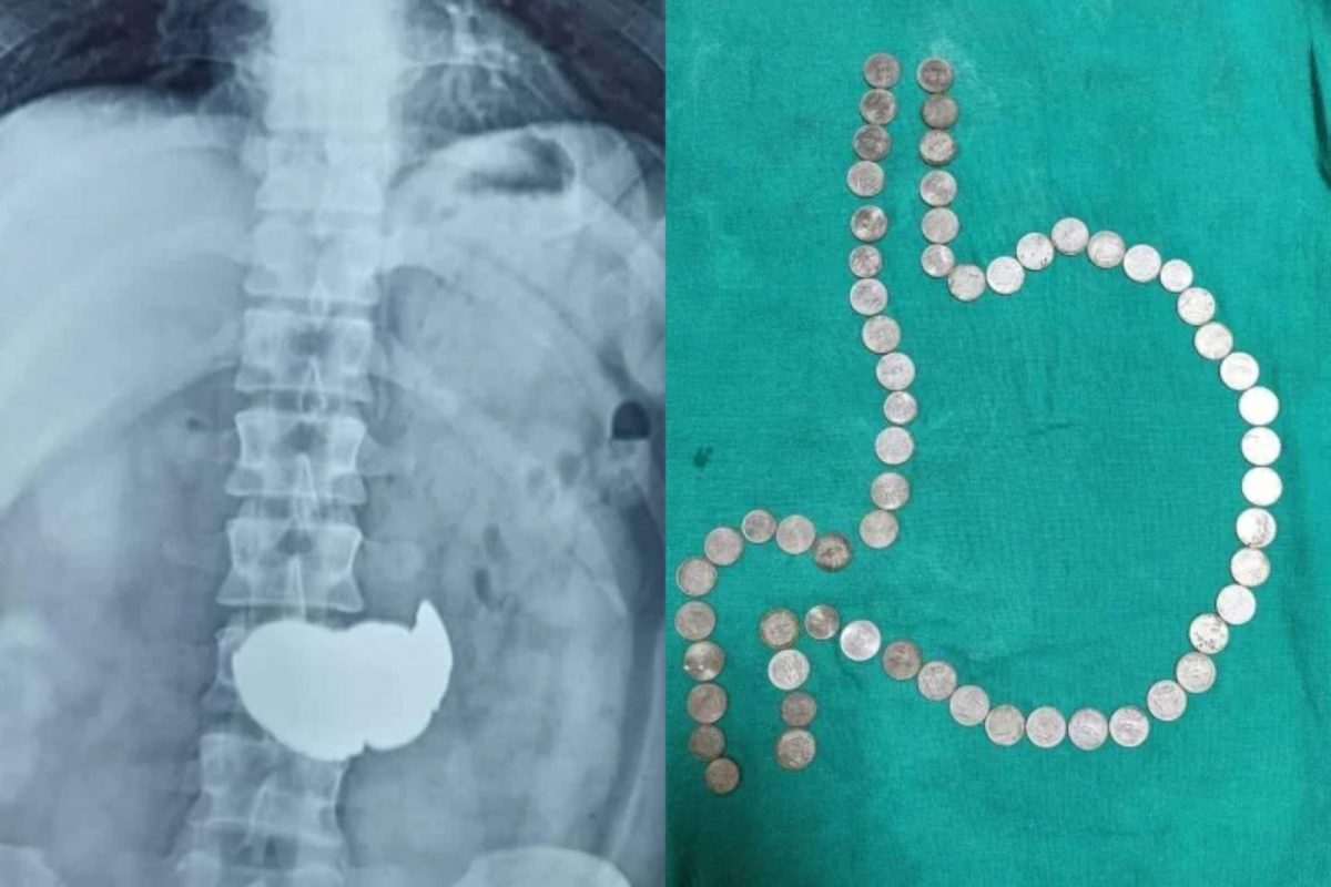 तरुणाने पोटाचा केला गल्ला; ऑपरेशन करुन 63 नाणी काढली बाहेर, डॉक्टर हैराण!