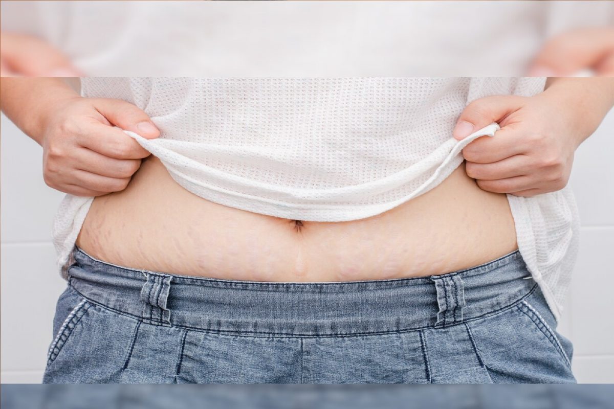 Stretch Marks : क्रीम्सची गरजच नाही; घरगुती उपाय करून घालवा प्रेग्नन्सी स्ट्रेच मार्क्स