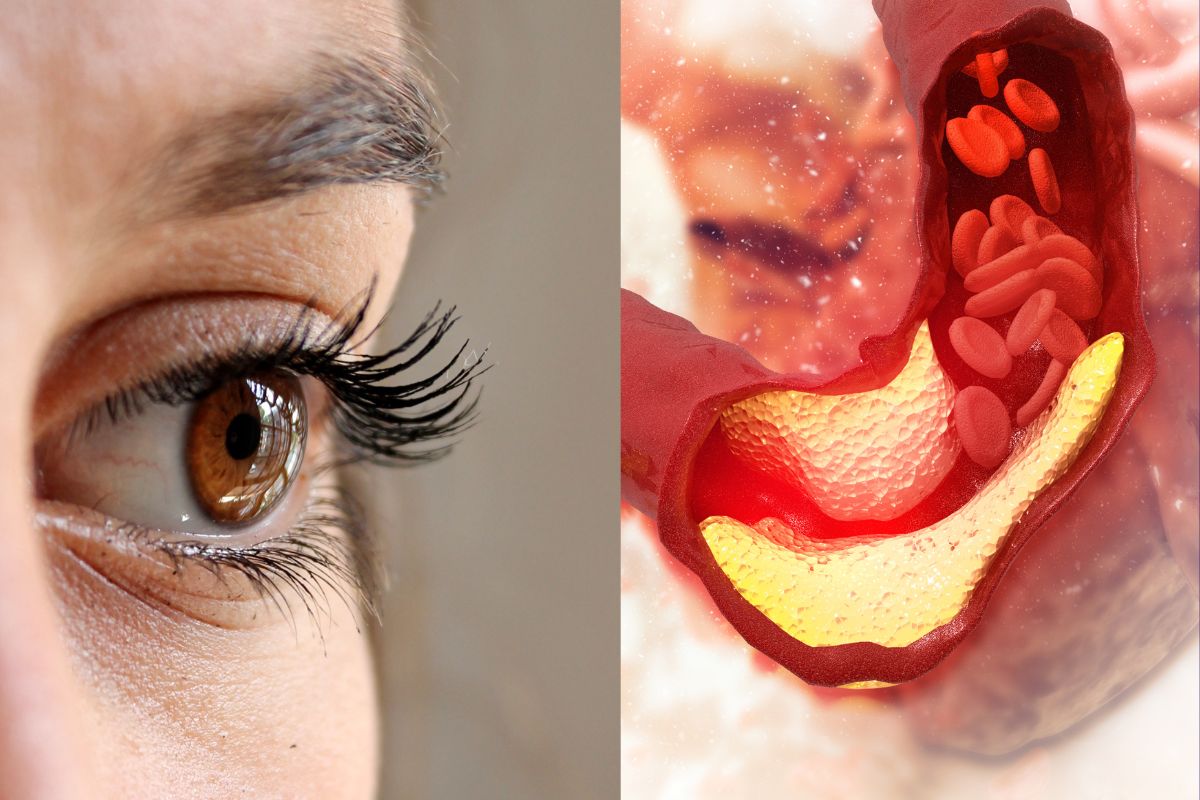 Cholesterol Level: डोळ्यांमधील हा अनैसर्गिक बदल असू शकतो हृदयरोगाचं लक्षण, दुर्लक्ष करणं पडेल महागात