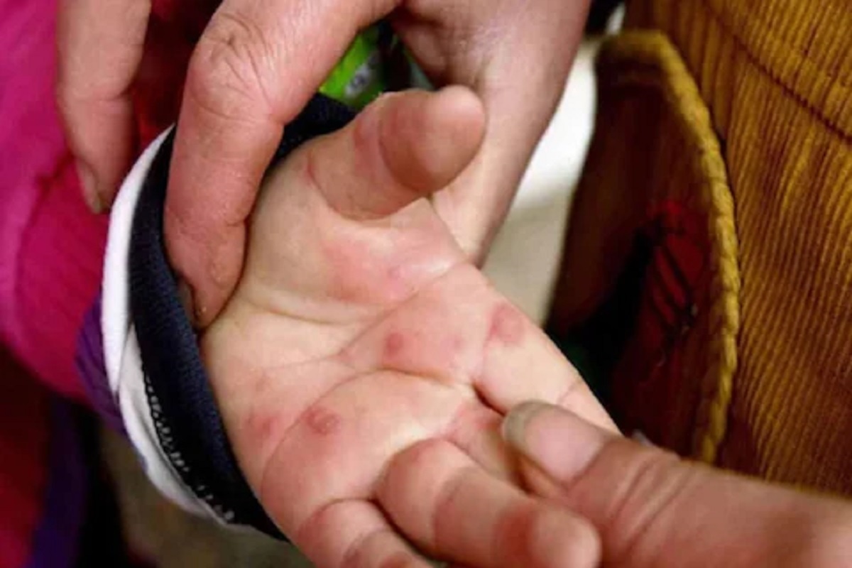 HFMD Alert ! टोमॅटो फ्लूचा धोका वाढला, केंद्र सरकारकडून गाइडलाईन्स जारी