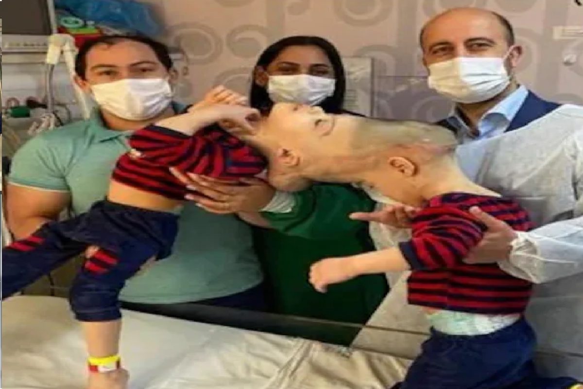 जन्मापासून जुळलेला होता मेंदू; डोक्याने जोडलेल्या Conjoined twins ना वेगळं करायला गेले डॉक्टर आणि...