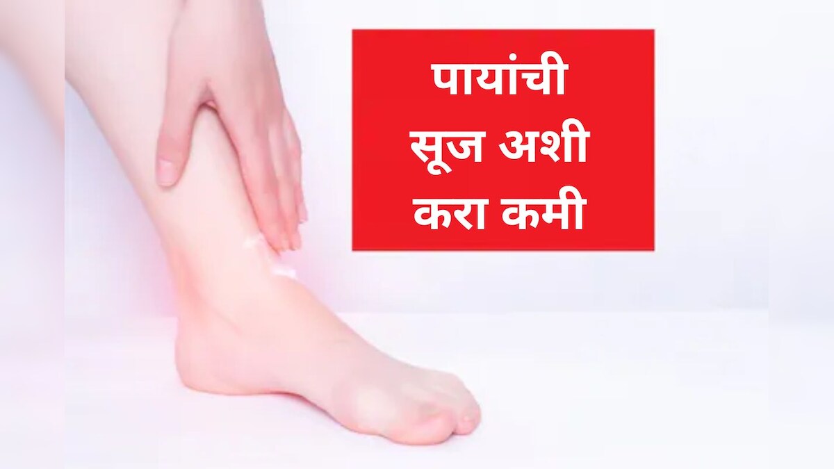 home-remedy-for-leg-swelling-get-relief-with-these-6-natural-remedies