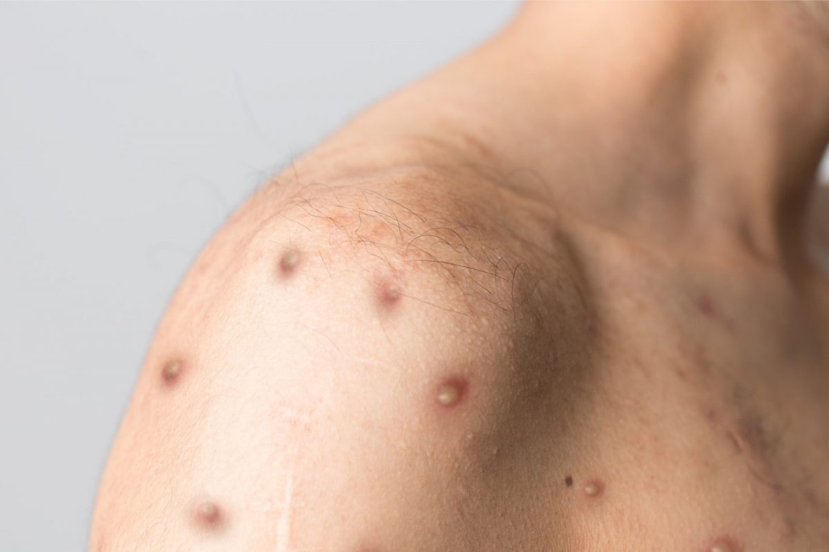 कोरोनापाठोपाठ मंकीपॉक्सचे थैमान! या देशात वाढले रुग्ण, WHO कडून अलर्ट