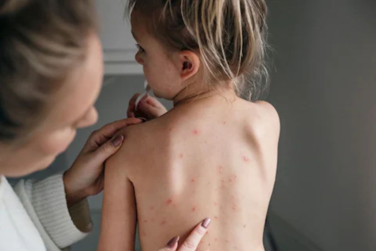 मंकीपॉक्सपासून वाचण्यासाठी सुपरफूड