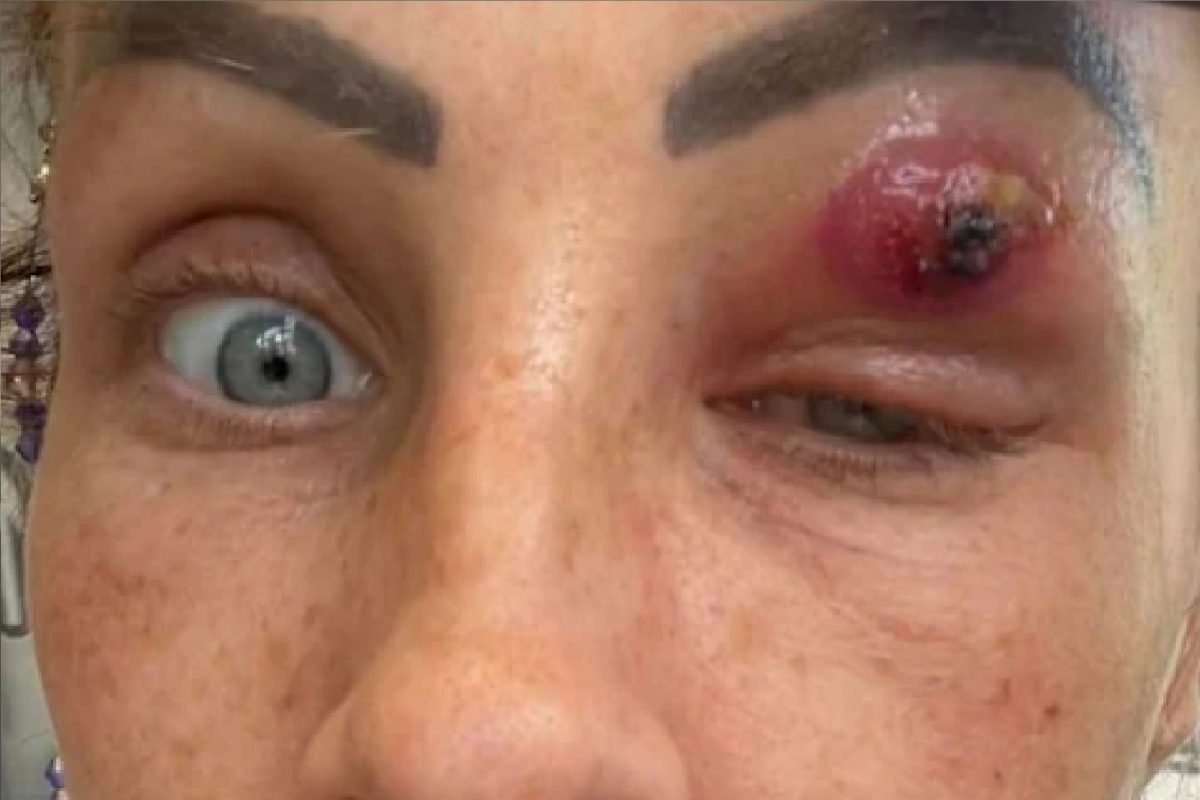 बापरे! साधी जखम म्हणून दुर्लक्ष केलं महिलेच्या डोळ्यातून अचानक बाहेर आला कीडा