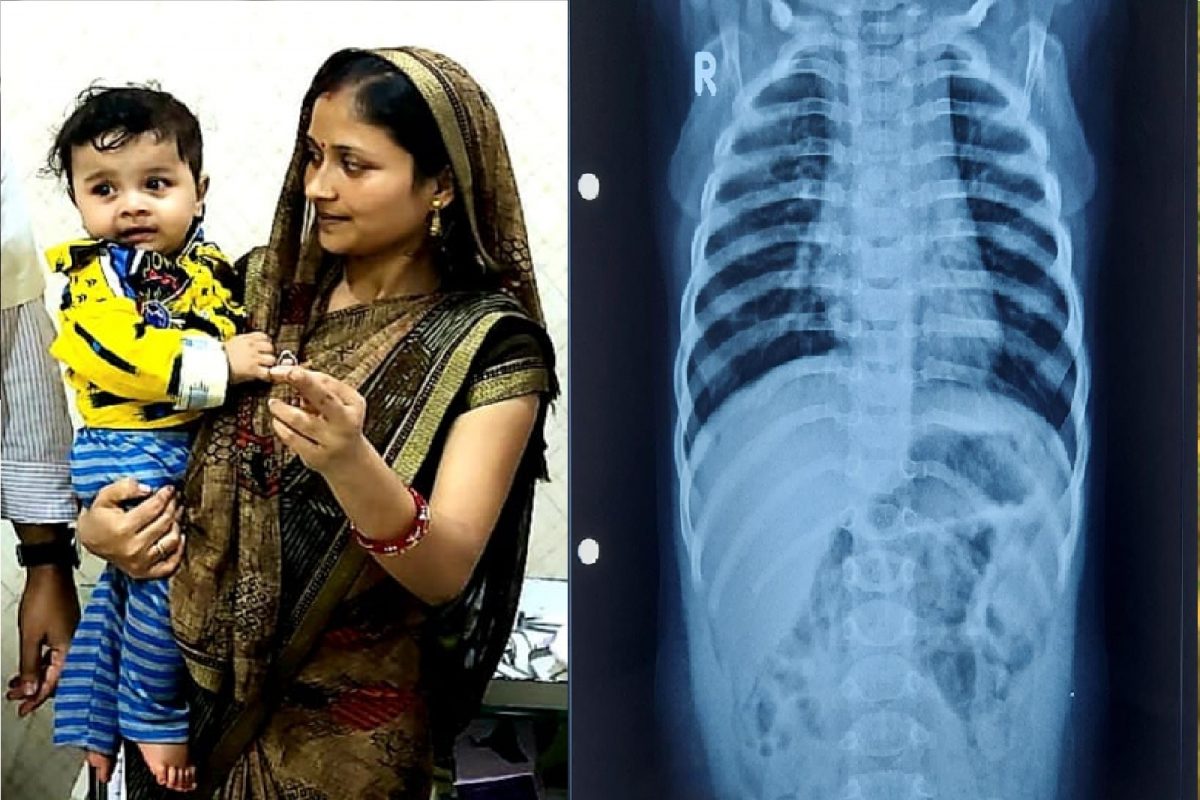 बाळाने असं काही गिळलं होतं ज्याची पालकांनाही माहिती नव्हती.