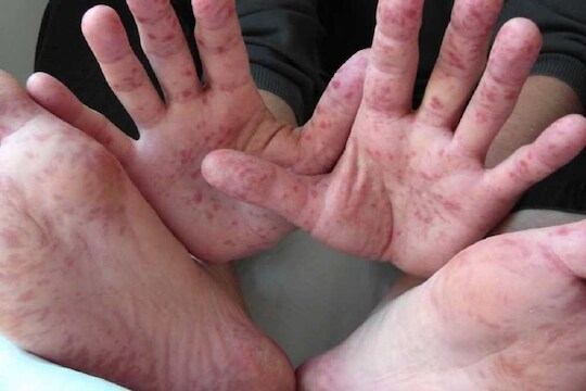 स्वाईन फ्लूसोबत आता Tomato Fever चा धोका वाढला, कशी घ्यायची काळजी?