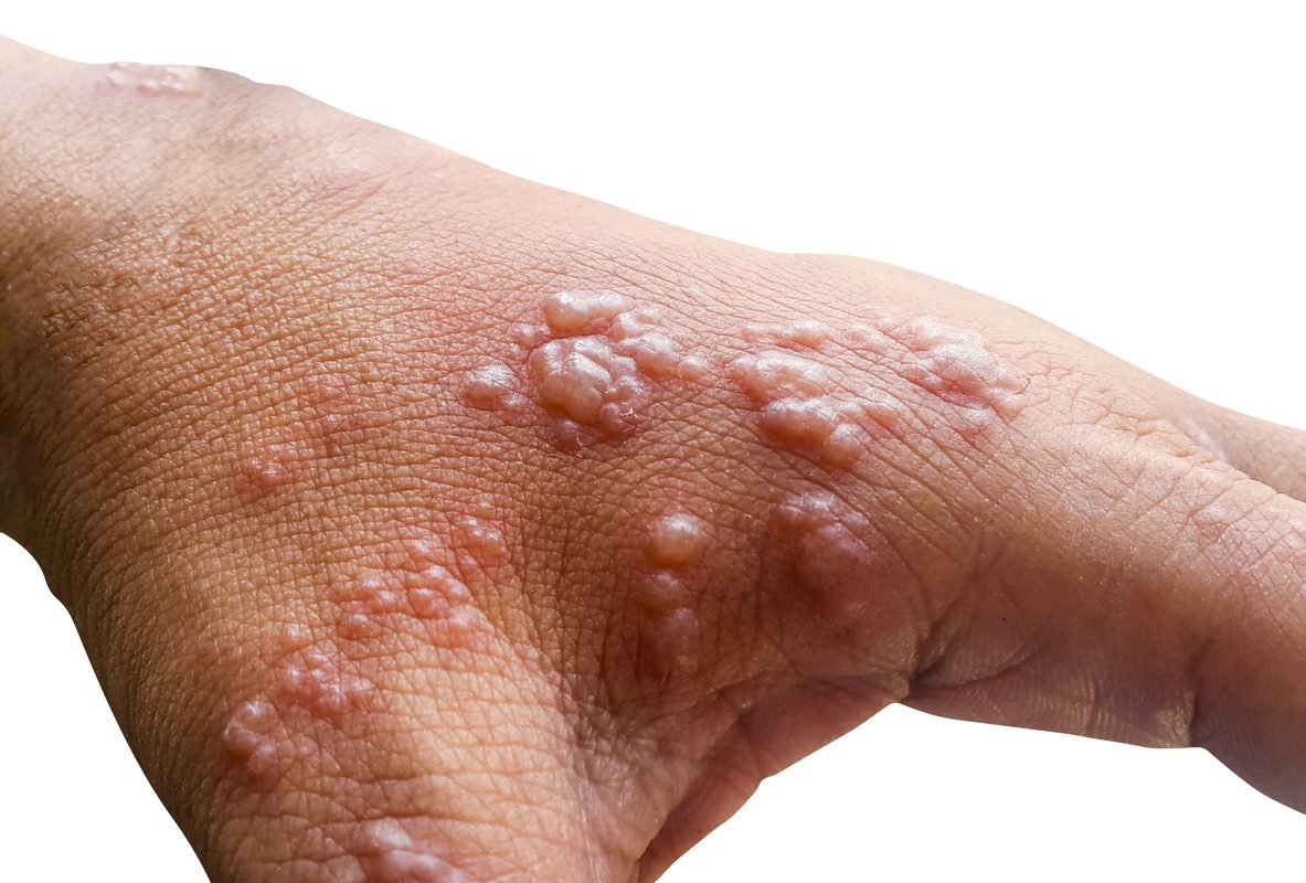 Skin infected Herpes zoster virus on the arms