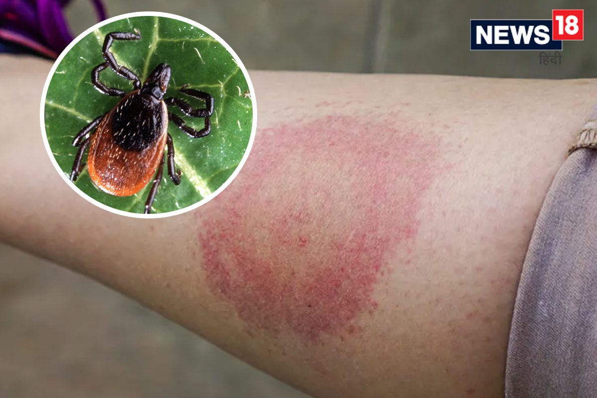 Lyme Disease ची का सुरू आहे जगभरात चर्चा? डोकेदुखीपासून सुरू होते या घातक आजाराची सुरुवात