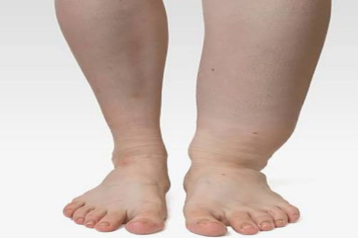 सावधान! नागपुरात पहिल्यांदाच वाढतोय हत्तीरोग, पाहा काय आहेत लक्षणं? Video