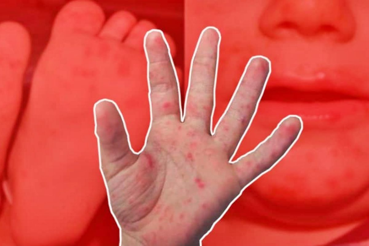 सावधान! मुलांमध्ये पसरतोय HMFD आजार, पाहा काय आहेत लक्षणं आणि उपाय Video