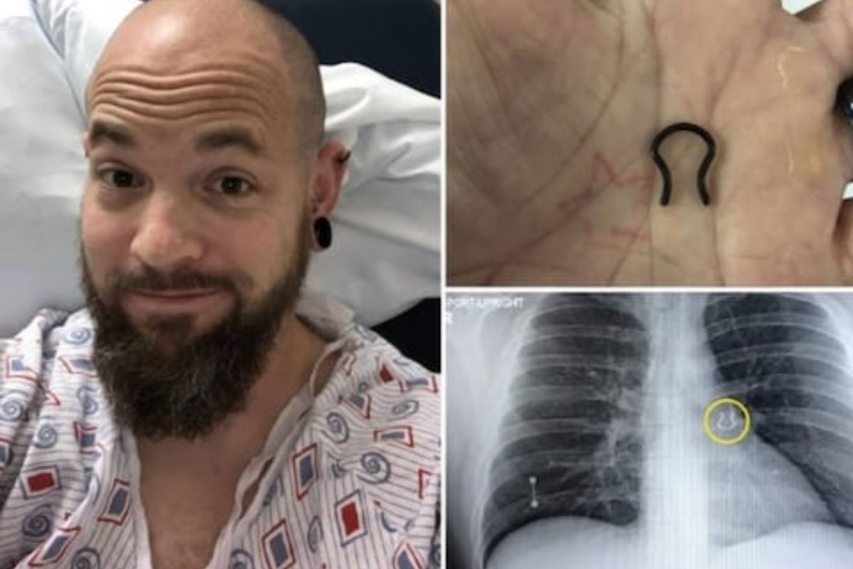 5 वर्षापूर्वी हरवलेली व्यक्तीच्या नाकातली रिंग; अखेर शरीराच्या अशा भागात सापडली की डॉक्टरही शॉक