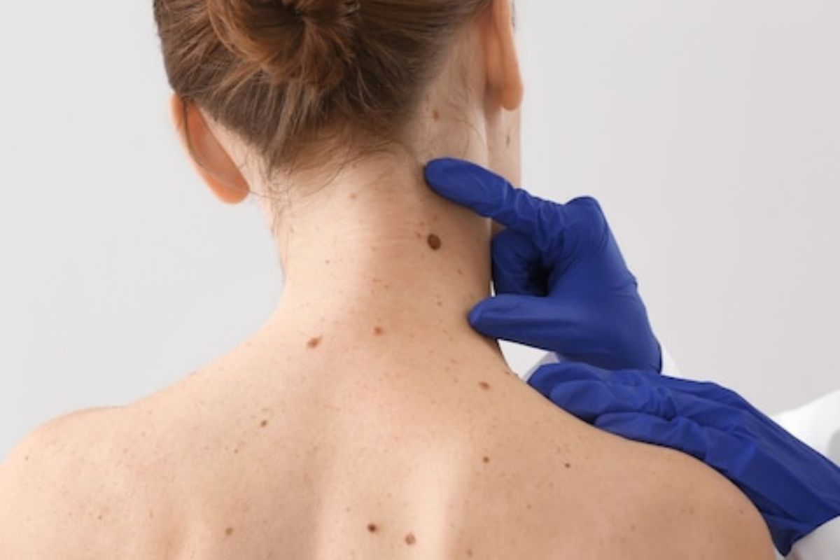 चेहरा किंवा मानेवर येणाऱ्या चामखिळी कॅन्सरचं लक्षण? काय आहे चामखीळ येण्यामागचं कारण?