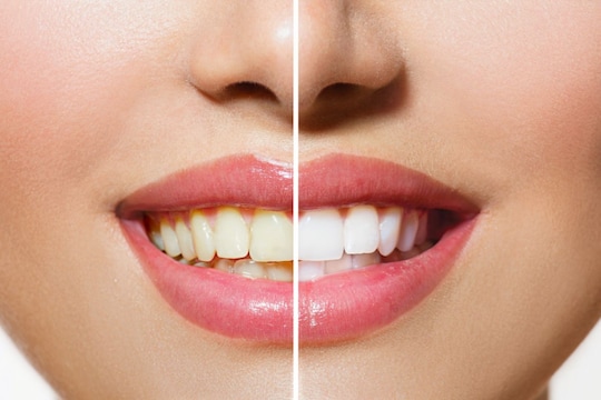 दात पांढरे करण्याचे उपाय 