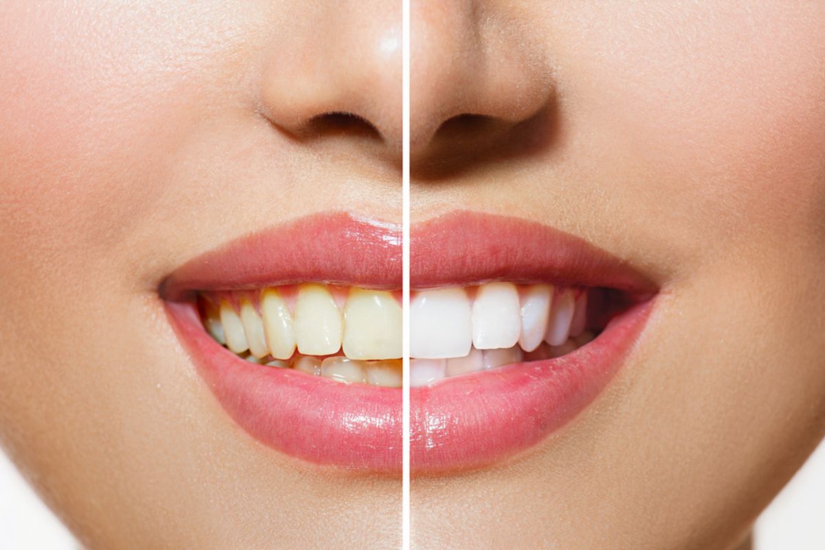 दात पांढरे करण्याचे उपाय