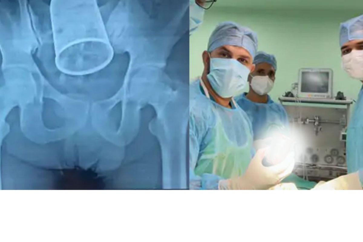 तरुणाच्या पोटात कसा अडकला स्टीलचा ग्लास; 11 डॉक्टरांपुढे उभा राहिला मोठा सवाल