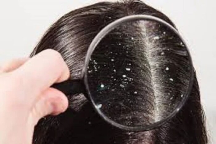 केसातील कोंडा काढण्यासाठी तुमच्या टाळूला लिंबाचा रस लावा आणि अँटी-डँड्रफ शैम्पूने धुण्यापूर्वी 10 मिनिटे राहू द्या. लिंबाच्या रसामध्ये सायट्रिक ऍसिड असते जे कूपांच्या मुळांपासून कोंडाविरूद्ध लढण्यास मदत करते. 