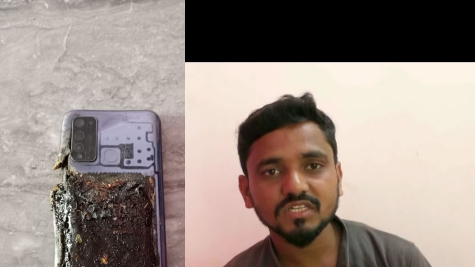 Whereas strolling, the cell phone saved in his pocket caught hearth, severely injured Ankit’s leg
Information WAALI