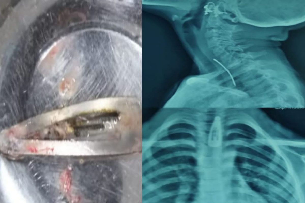 कोल्हापूर : 7 वर्षांच्या बाळाने गिळली केसातील पिन; पुढे काय झालं पाहा