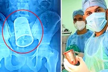 22 वर्षीय तरुणाच्या पोटात मिळाला स्टीलचा ग्लास, पाहून डॉक्टरांना बसला शॉक 22 वर्षीय तरुणाच्या पोटात मिळाला स्टीलचा ग्लास, पाहून डॉक्टरांना बसला शॉक