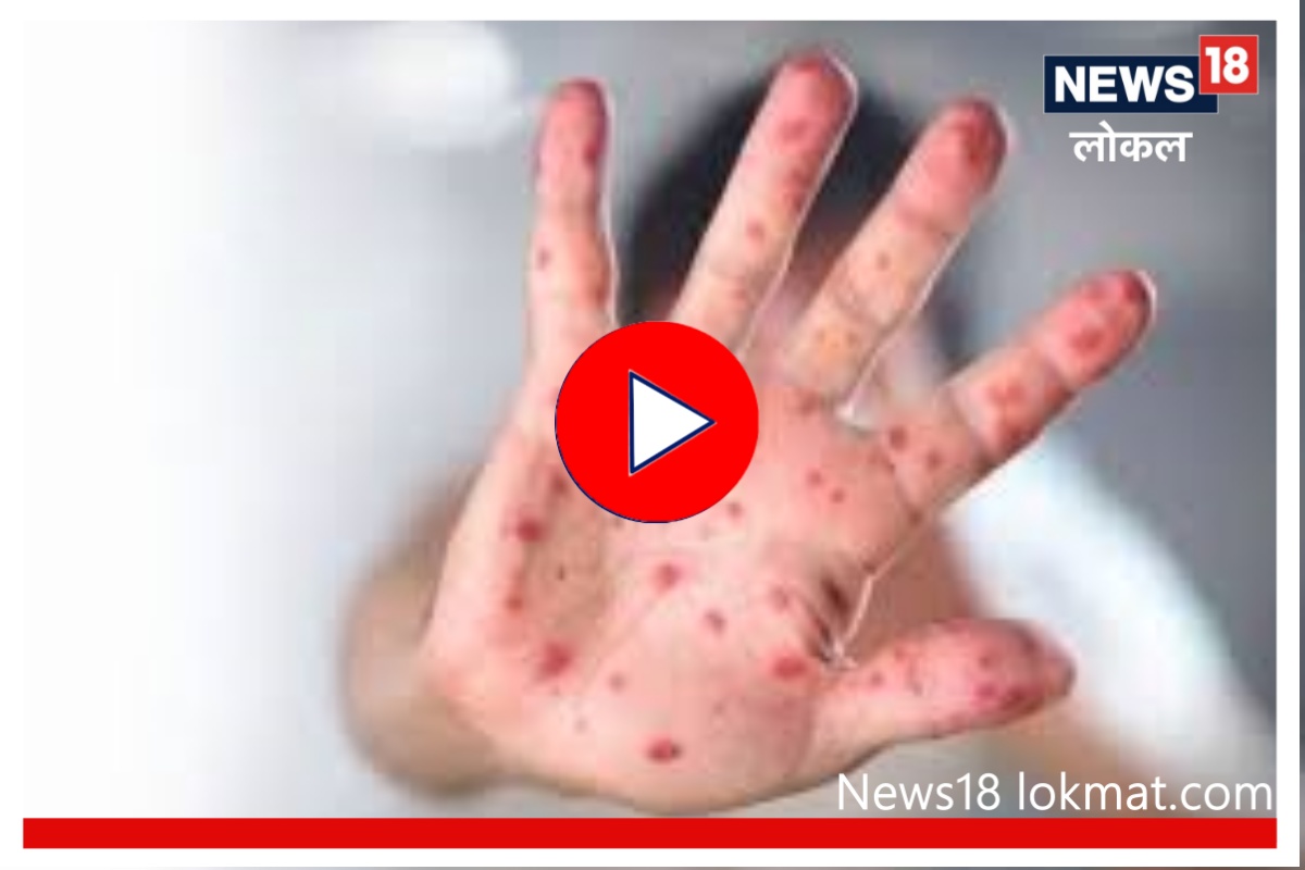 Video: मुंबईनंतर औरंगाबादमध्ये गोवरचा शिरकाव, मुलांचं प्रमाण मोठं असल्यानं पालकांना टेन्शन!