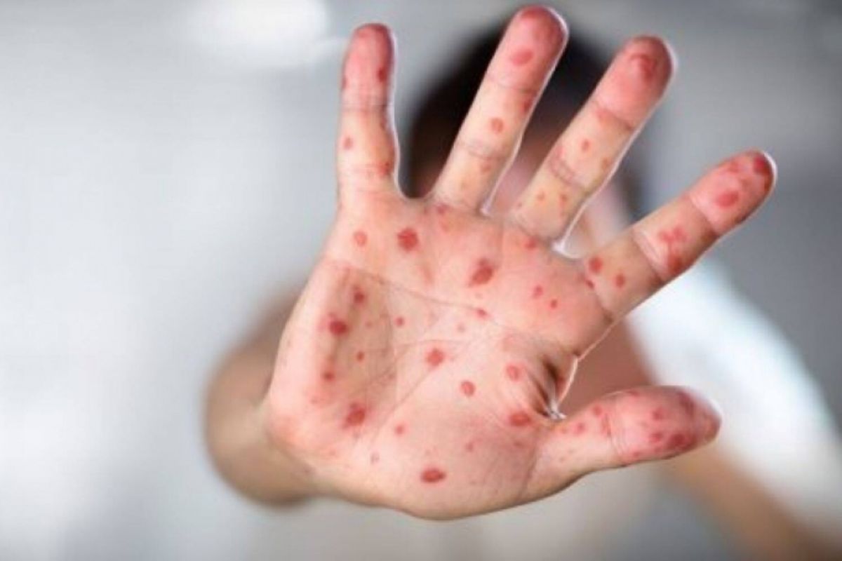 धक्कादायक! ठाण्यात गोवरचा कहर, चार रुग्णांचा मृत्यू