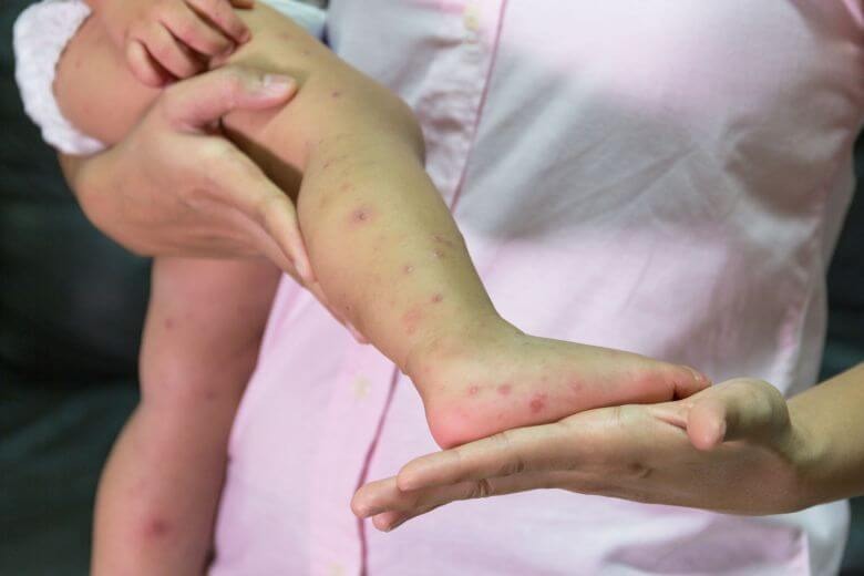 Measles Disease in Mumbai : कोरोनानंतर मुंबईत गोवरचं थैमान, आतापर्यंत 7 बालके दगावली तर 61 रुग्णालयात