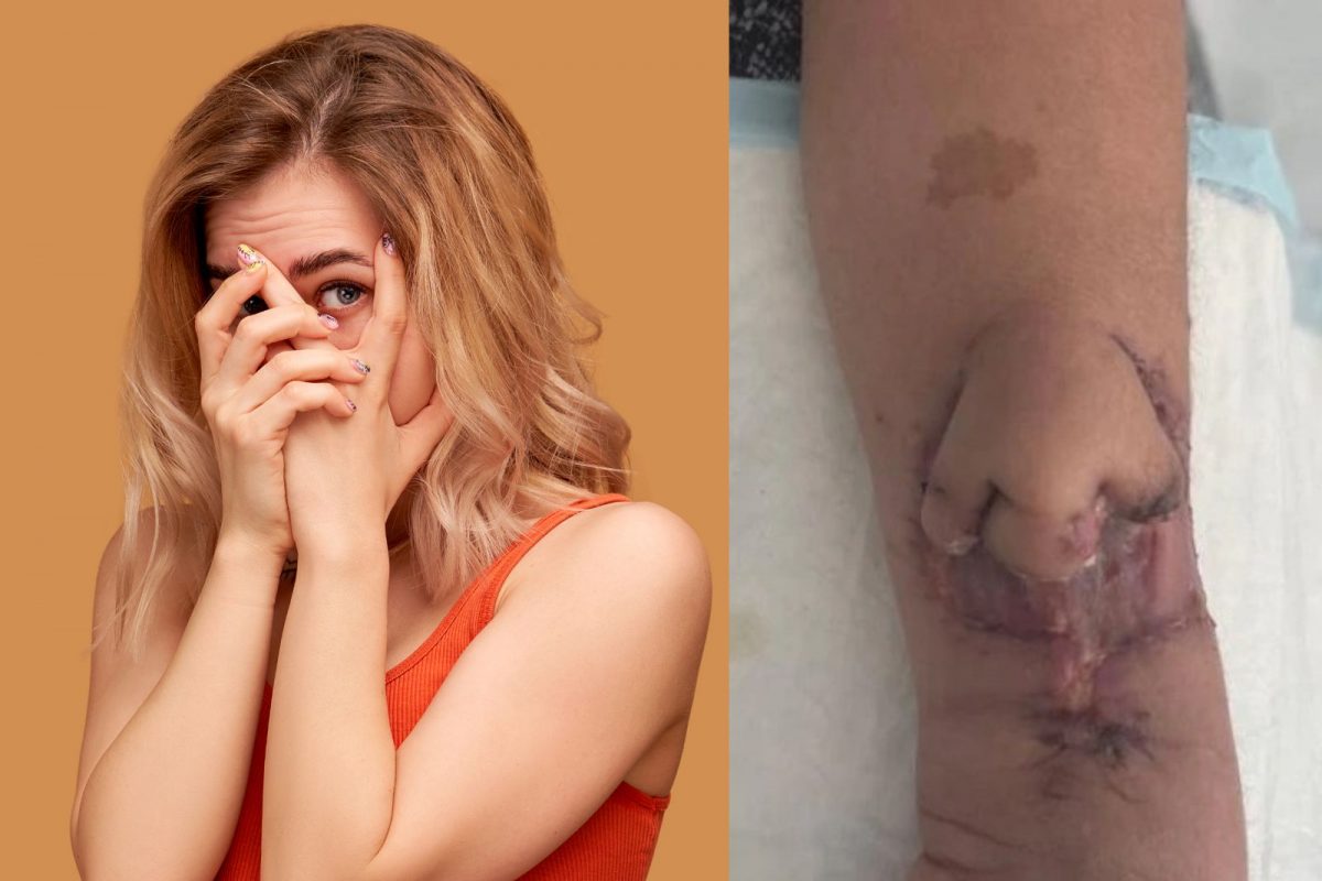 हातावर नाक