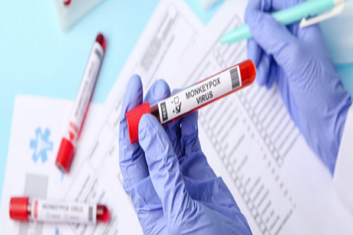 ...तर मंकीपॉक्स घेणार कोरोनापेक्षाही घातक महामारीचं रूप, संशोधनातून चिंता वाढवणारी माहिती समोर