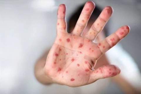 Aurangabad Measles Update : मुंबईत आलेला गोवर आता राज्यभर पसरतोय; औरंगाबादमध्ये थैमान, आरोग्य मंत्री आहेत तरी कुठे?