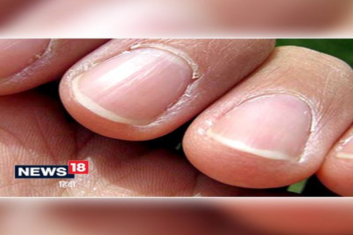 What to do for peeling cuticles around nails? - Dr. Rasya Dixit | Doctors'  Circle - YouTube