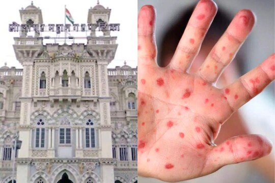 सोलापूरमध्ये गोवरचा धोका वाढला, महापालिका राबवणार विशेष मोहीम