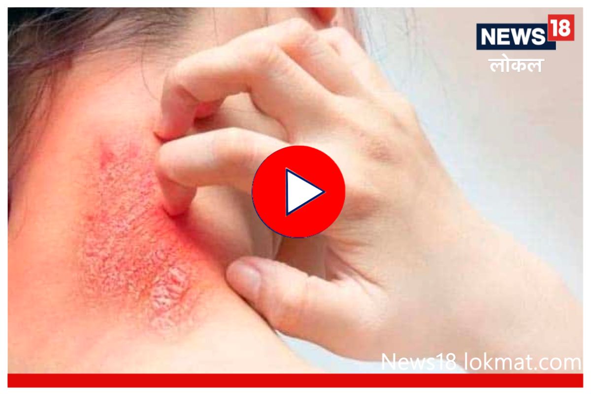 नाशिकमध्ये वाढला त्वचारोगाचा धोका, 'ही' लक्षणं आढळल्यास लगेच करा तपासणी, Video