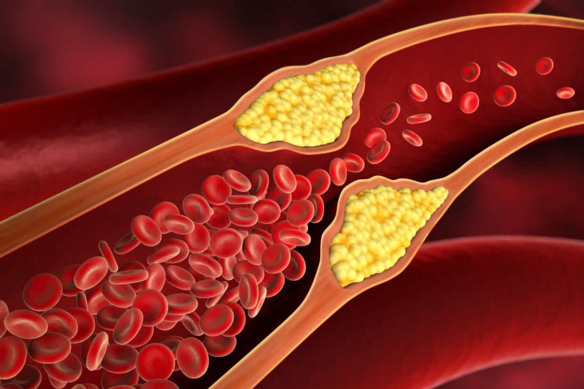 बॅड कोलेस्टेरॉल