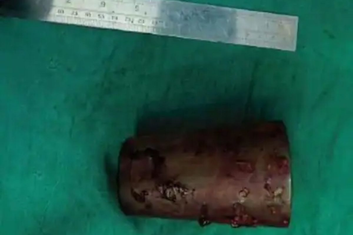 नशेत ग्लासवर बसला व्यक्ती; थेट पोटातच शिरला, 3 दिवसांनी झाली अशी अवस्था