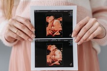 नागपूर-आईच्या पोटातच अडकलं मूल, बाहेर येईपर्यंत गेली 15 वर्षे, बाळाची अशी अवस्था